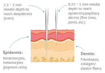 Microneedling Diagram Microneedling Diagram