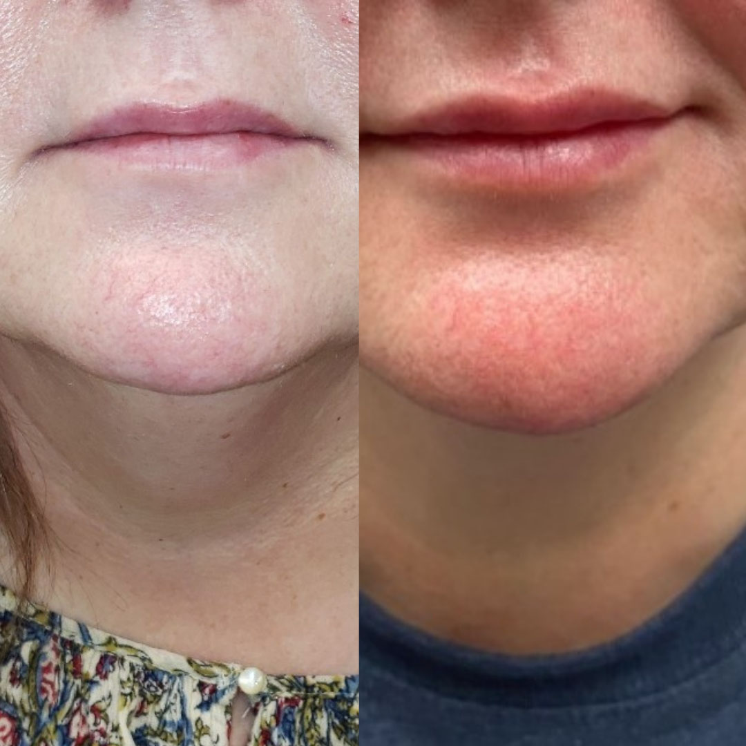 Before and After Photos of Injectable (Filler) Treatments Before and After Photos of Injectable (Filler) Treatments