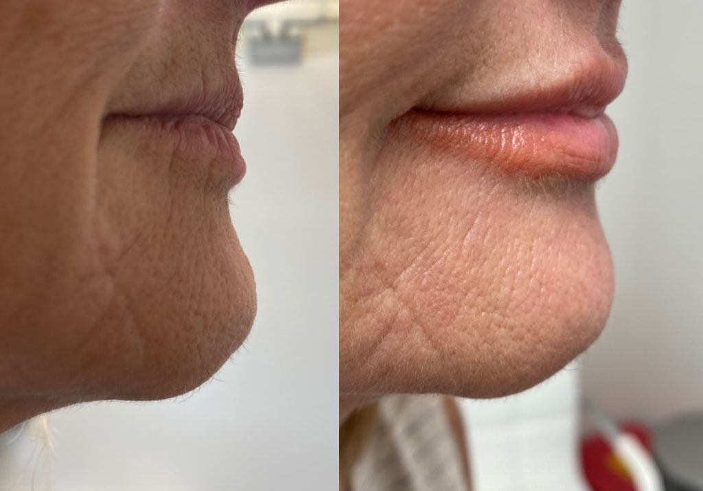 Before and After Photos of Injectable (Filler) Treatments Before and After Photos of Injectable (Filler) Treatments